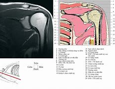 Mri Khớp Vai Xray